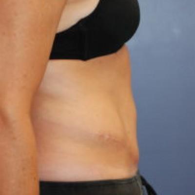 Tummy Tuck after at Samuel Lin, MD, FACS in Boston, MA