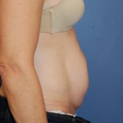 Tummy Tuck before at Samuel Lin, MD, FACS in Boston, MA