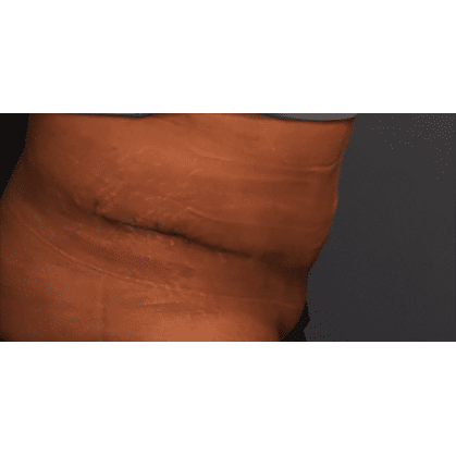 Tummy Tuck after at Samuel Lin, MD, FACS in Boston, MA