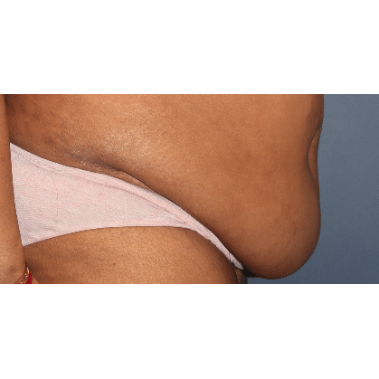 Tummy Tuck before at Samuel Lin, MD, FACS in Boston, MA