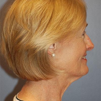 Deep Plane Facelift before at Samuel Lin, MD, FACS in Boston, MA