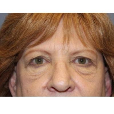 Blepharoplasty before at Samuel Lin, MD, FACS in Boston, MA
