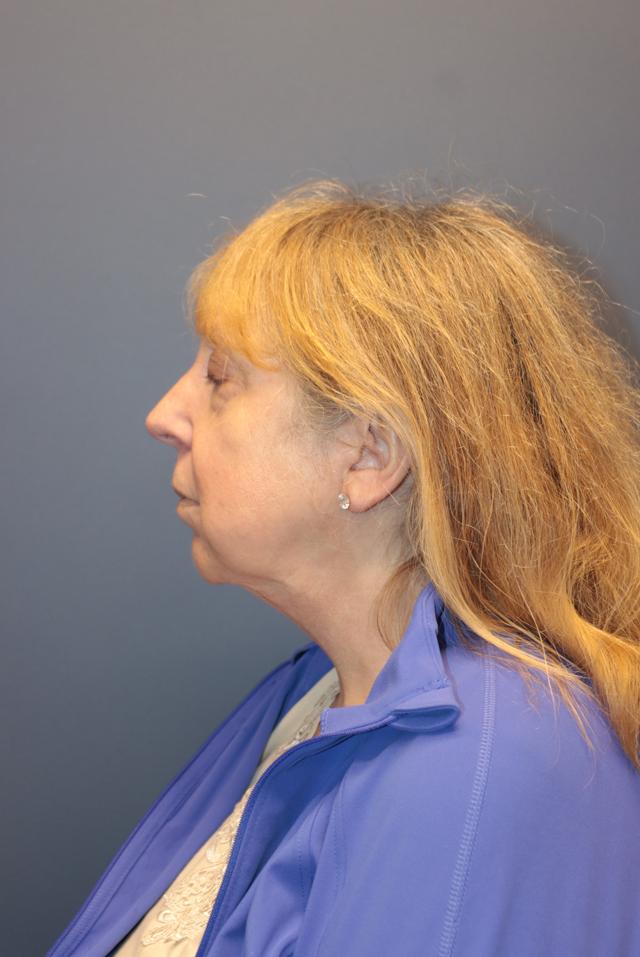 Deep Plane Facelift before at Samuel Lin, MD, FACS in Boston, MA