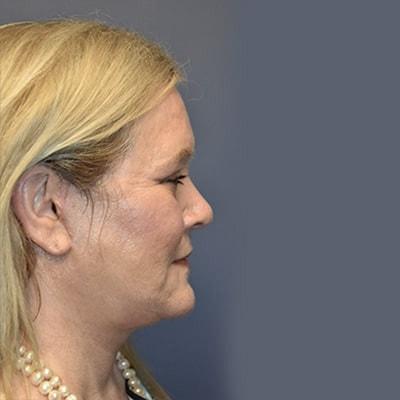Deep Plane Facelift after at Samuel Lin, MD, FACS in Boston, MA