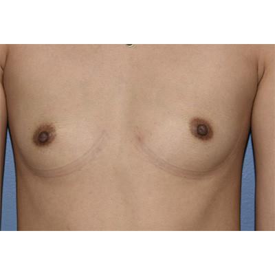 Breast Augmentation before at Samuel Lin, MD, FACS in Boston, MA