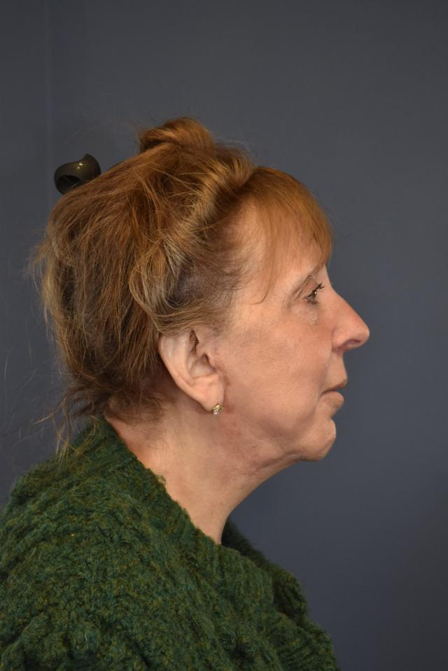 Deep Plane Facelift after at Samuel Lin, MD, FACS in Boston, MA