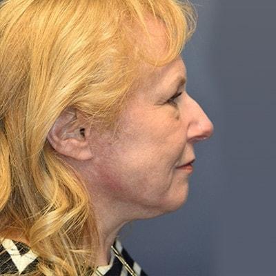 Samuel Lin, MD, FACS neck lift after — Boston, MA