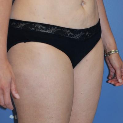 Liposuction after at Samuel Lin, MD, FACS in Boston, MA