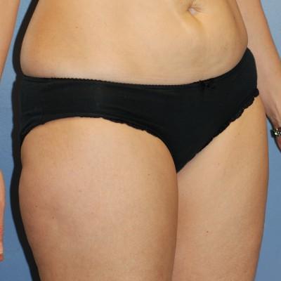 Liposuction before at Samuel Lin, MD, FACS in Boston, MA