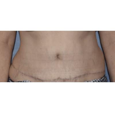 Tummy Tuck after at Samuel Lin, MD, FACS in Boston, MA
