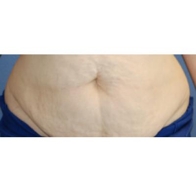 Tummy Tuck before at Samuel Lin, MD, FACS in Boston, MA
