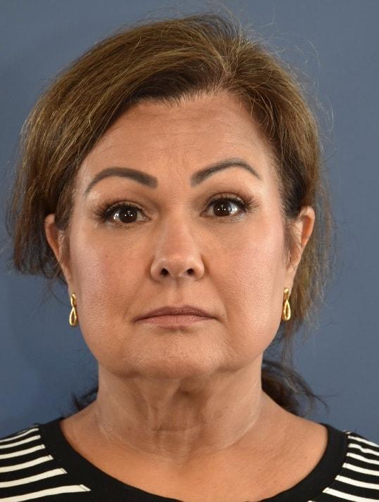 Deep Plane Facelift before at Samuel Lin, MD, FACS in Boston, MA