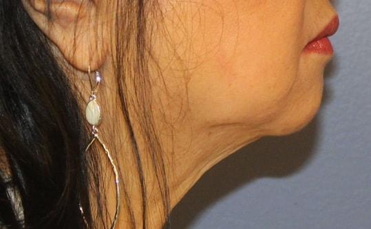 Neck Lift before at Samuel Lin, MD, FACS in Boston, MA