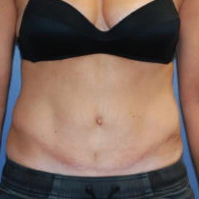 Tummy Tuck after at Samuel Lin, MD, FACS in Boston, MA