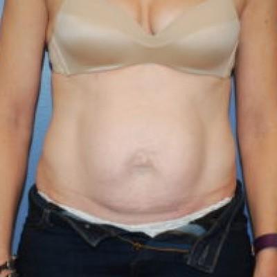 Tummy Tuck before at Samuel Lin, MD, FACS in Boston, MA