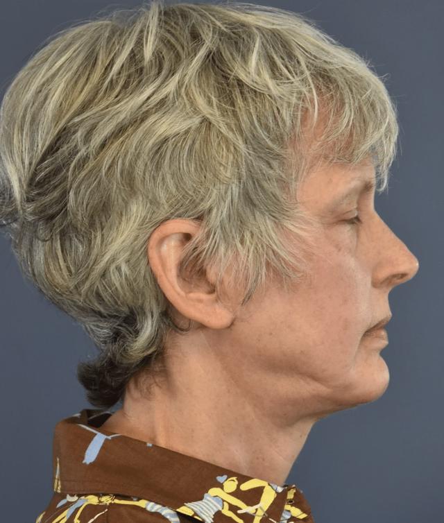 Deep Plane Facelift after at Samuel Lin, MD, FACS in Boston, MA