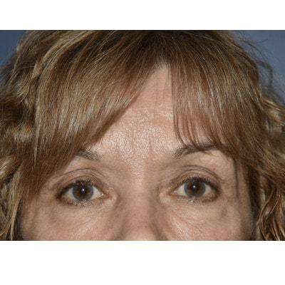 Blepharoplasty before at Samuel Lin, MD, FACS in Boston, MA