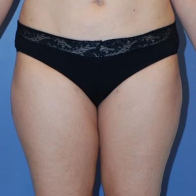 Liposuction after at Samuel Lin, MD, FACS in Boston, MA