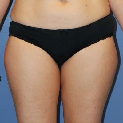 Liposuction before at Samuel Lin, MD, FACS in Boston, MA