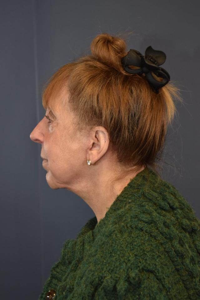 Deep Plane Facelift after at Samuel Lin, MD, FACS in Boston, MA