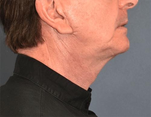 Neck Lift after at Samuel Lin, MD, FACS in Boston, MA