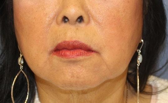 Neck Lift before at Samuel Lin, MD, FACS in Boston, MA