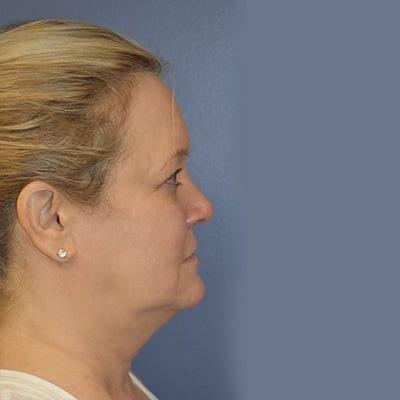 Deep Plane Facelift before at Samuel Lin, MD, FACS in Boston, MA