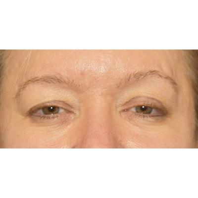 Blepharoplasty before at Samuel Lin, MD, FACS in Boston, MA