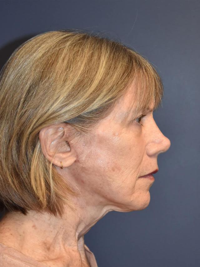Deep Plane Facelift after at Samuel Lin, MD, FACS in Boston, MA