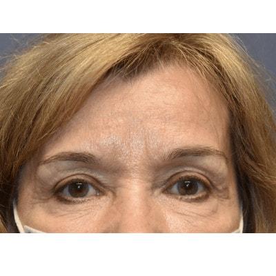 Blepharoplasty after at Samuel Lin, MD, FACS in Boston, MA