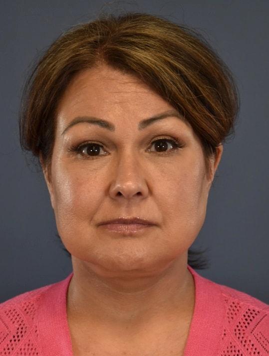 Deep Plane Facelift after at Samuel Lin, MD, FACS in Boston, MA