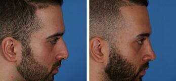 Rhinoplasty result at Totonchi Plastic Surgery in Cleveland, OH