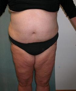 Zellner Plastic Surgery & Dr. Mordcai Blau body lift after — White Plains, NY