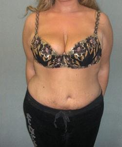 Zellner Plastic Surgery & Dr. Mordcai Blau body lift after — White Plains, NY