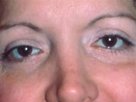Zellner Plastic Surgery & Dr. Mordcai Blau eyelid lift after — White Plains, NY