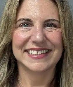 Zellner Plastic Surgery & Dr. Mordcai Blau facelift after — White Plains, NY