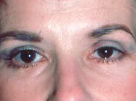 Zellner Plastic Surgery & Dr. Mordcai Blau eyelid lift after — White Plains, NY