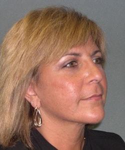 Zellner Plastic Surgery & Dr. Mordcai Blau facelift after — White Plains, NY