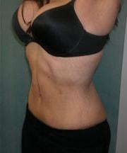 Zellner Plastic Surgery & Dr. Mordcai Blau body lift after — White Plains, NY
