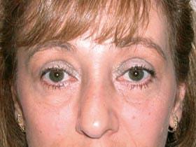 Zellner Plastic Surgery & Dr. Mordcai Blau eyelid lift after — White Plains, NY