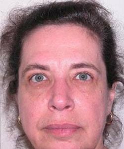 Zellner Plastic Surgery & Dr. Mordcai Blau eyelid lift after — White Plains, NY