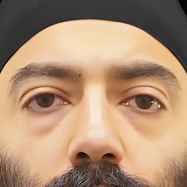 Blepharoplasty before at Fulcrum Aesthetics and Surgery in Chicago, IL