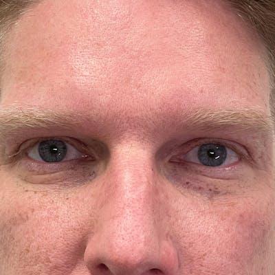 Blepharoplasty before at Fulcrum Aesthetics and Surgery in Chicago, IL