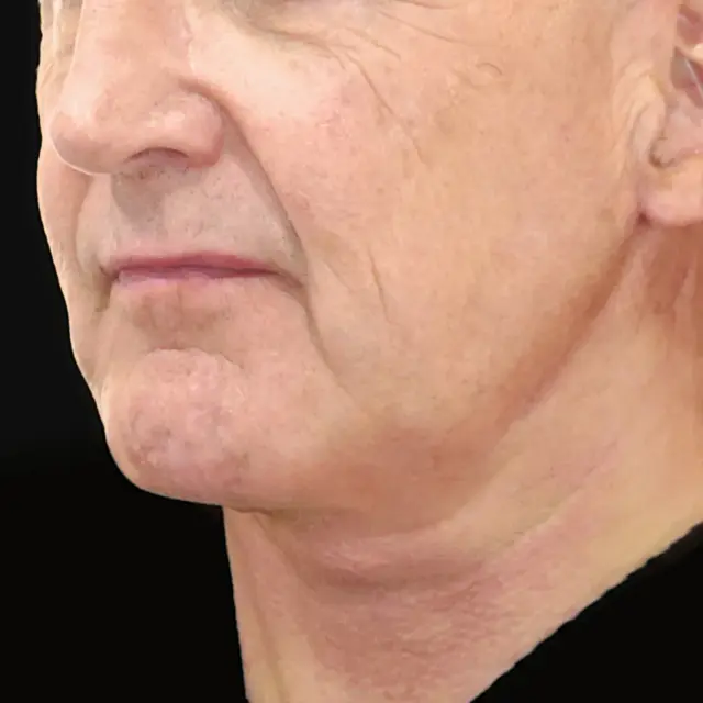 Facelift after at Fulcrum Aesthetics and Surgery in Chicago, IL