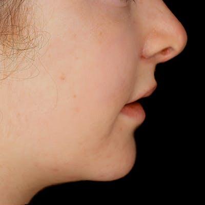 Fulcrum Aesthetics and Surgery rhinoplasty after — Chicago, IL