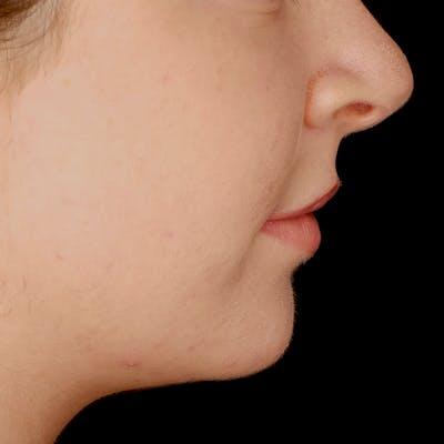 Rhinoplasty before at Fulcrum Aesthetics and Surgery in Chicago, IL