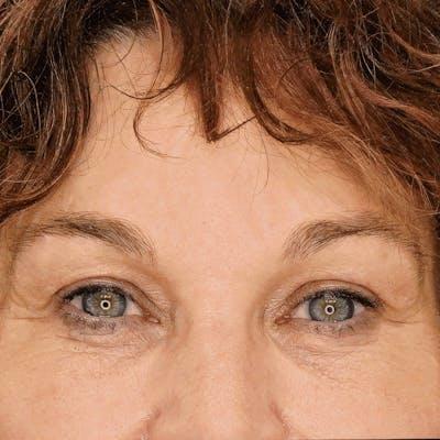 Fulcrum Aesthetics and Surgery after — Chicago, IL