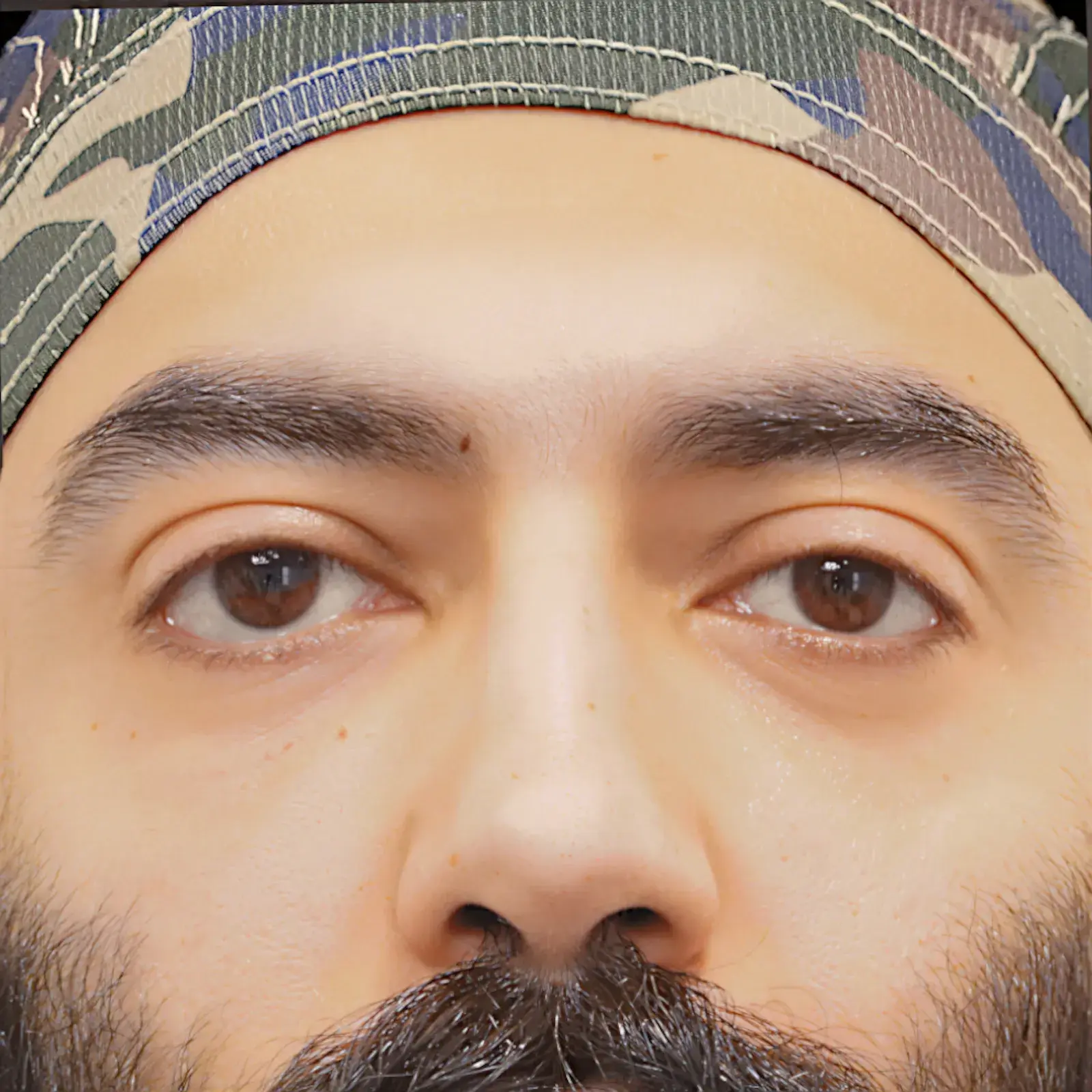 Fulcrum Aesthetics and Surgery eyelid lift after — Chicago, IL