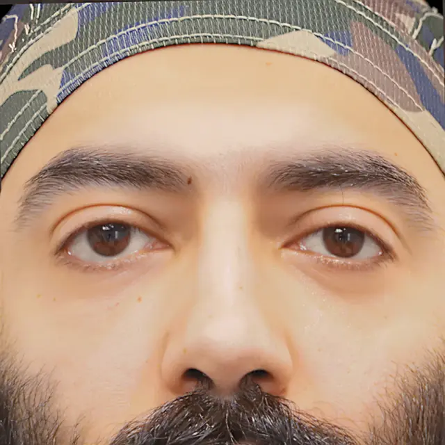 Blepharoplasty after at Fulcrum Aesthetics and Surgery in Chicago, IL