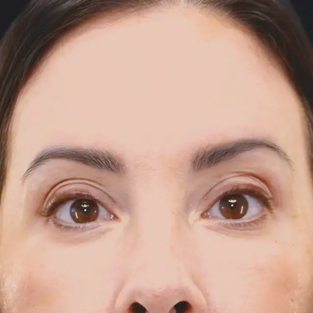 Blepharoplasty after at Fulcrum Aesthetics and Surgery in Chicago, IL